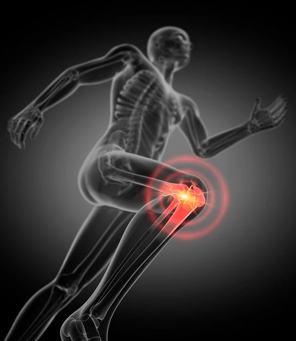 X-ray illustration of a running man with pain in knee joint